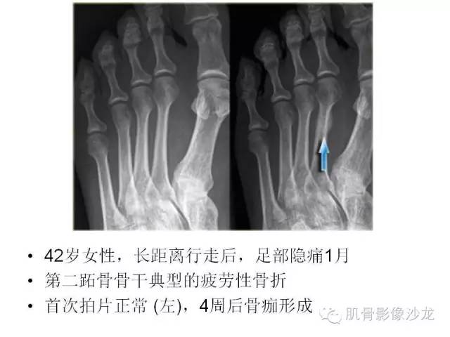 【PPT】重视应力性骨损伤的诊断