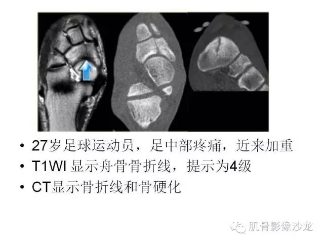 【PPT】重视应力性骨损伤的诊断
