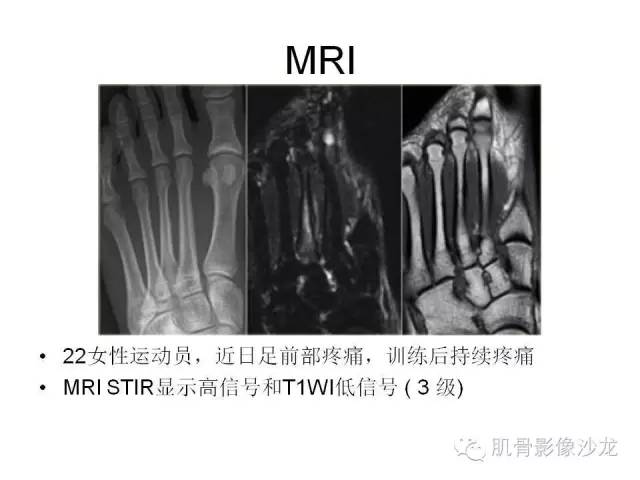 【PPT】重视应力性骨损伤的诊断