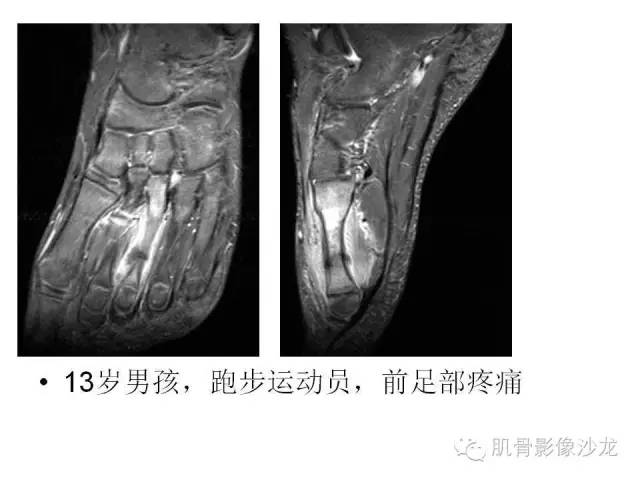 【PPT】重视应力性骨损伤的诊断