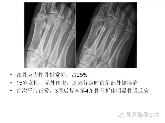 【PPT】重视应力性骨损伤的诊断