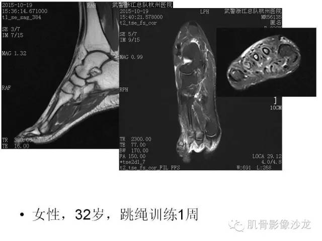 【PPT】重视应力性骨损伤的诊断