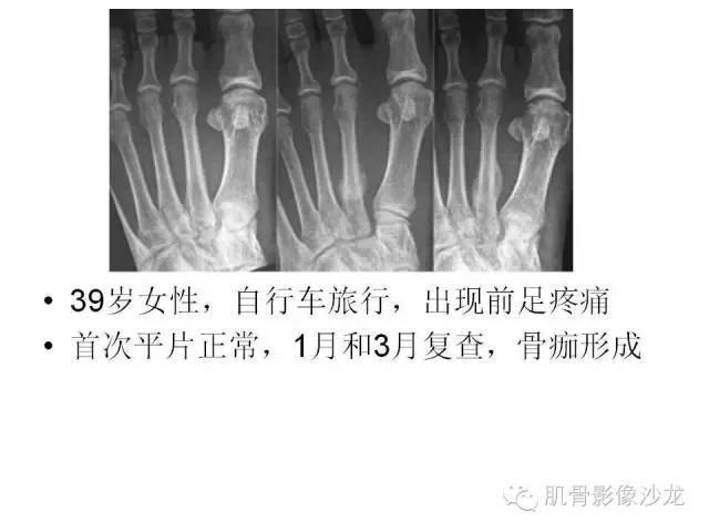 【PPT】重视应力性骨损伤的诊断