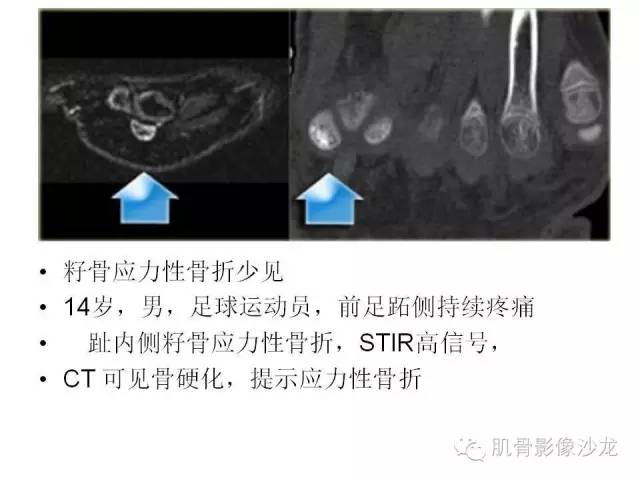 【PPT】重视应力性骨损伤的诊断