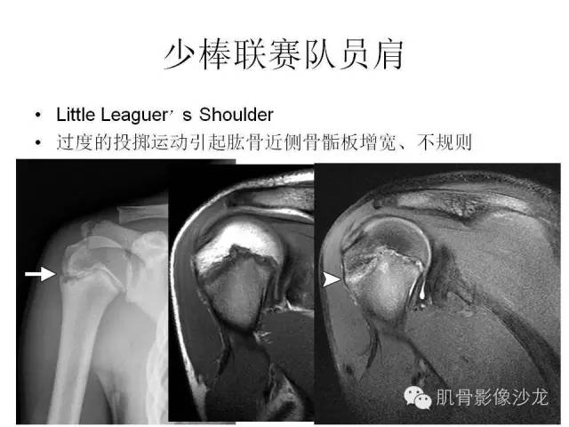 【PPT】重视应力性骨损伤的诊断