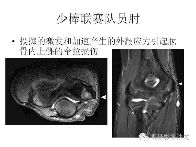 【PPT】重视应力性骨损伤的诊断