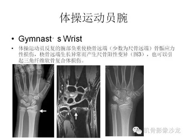【PPT】重视应力性骨损伤的诊断