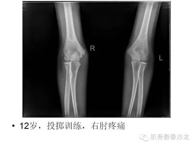 【PPT】重视应力性骨损伤的诊断