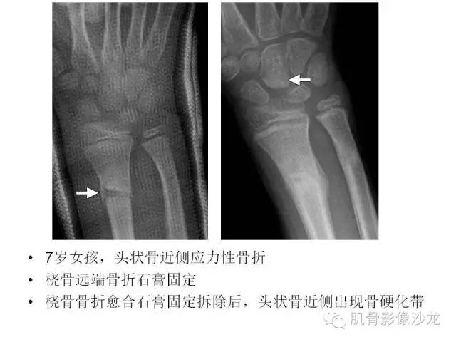 【PPT】重视应力性骨损伤的诊断