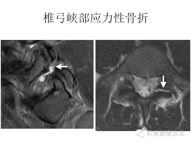 【PPT】重视应力性骨损伤的诊断