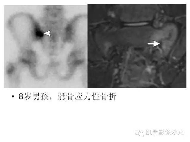 【PPT】重视应力性骨损伤的诊断