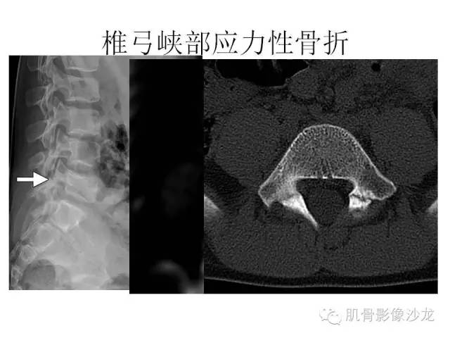 【PPT】重视应力性骨损伤的诊断