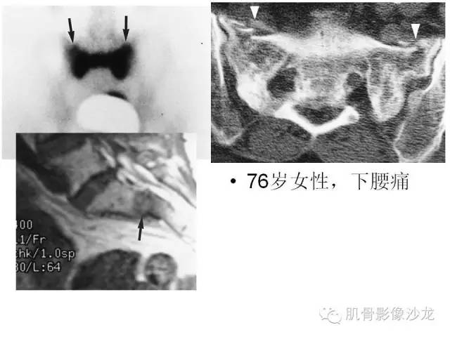 【PPT】重视应力性骨损伤的诊断