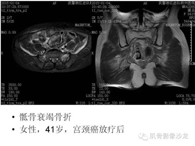 【PPT】重视应力性骨损伤的诊断