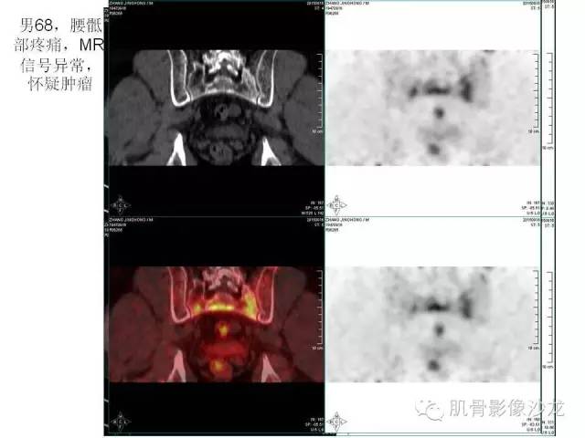 【PPT】重视应力性骨损伤的诊断