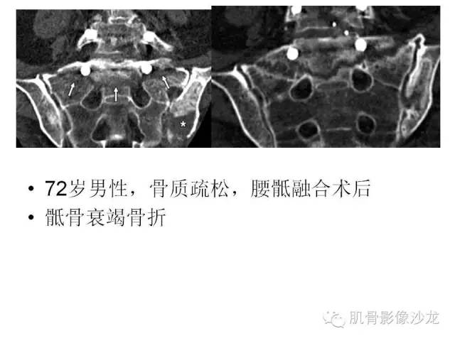 【PPT】重视应力性骨损伤的诊断