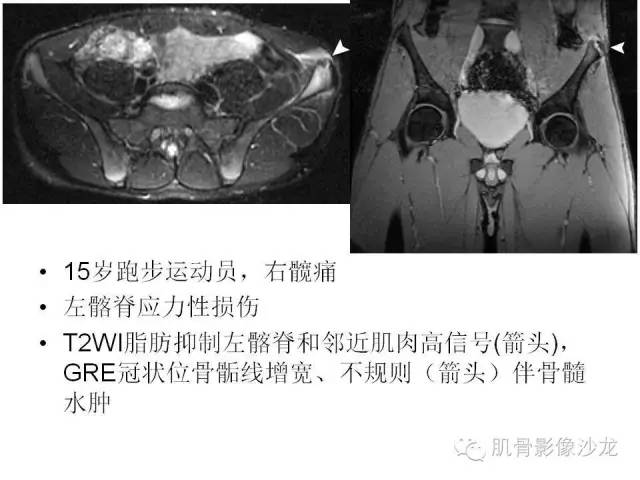 【PPT】重视应力性骨损伤的诊断