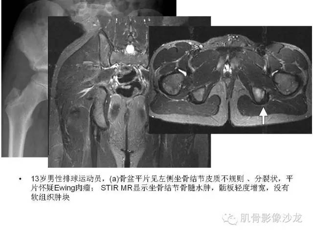 【PPT】重视应力性骨损伤的诊断