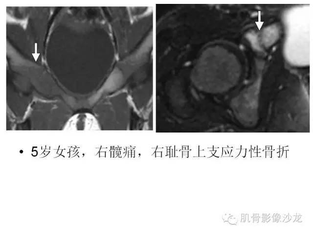 【PPT】重视应力性骨损伤的诊断