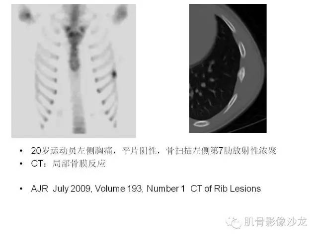 【PPT】重视应力性骨损伤的诊断