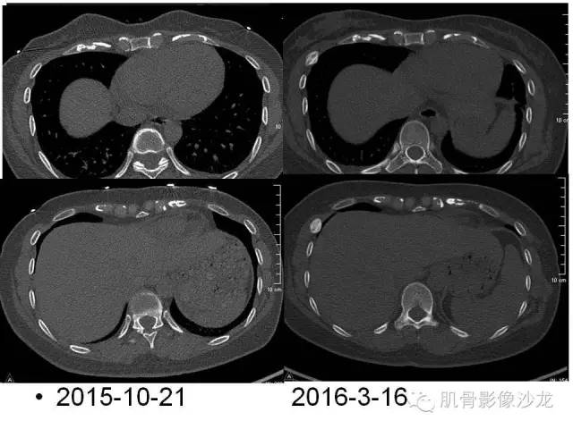 【PPT】重视应力性骨损伤的诊断
