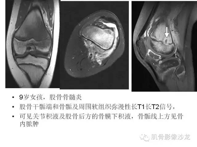 【PPT】重视应力性骨损伤的诊断