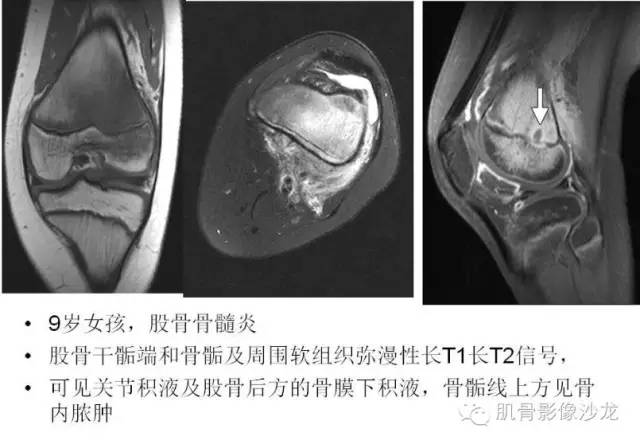 【PPT】重视应力性骨损伤的诊断