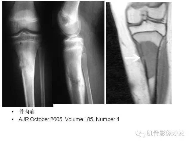 【PPT】重视应力性骨损伤的诊断