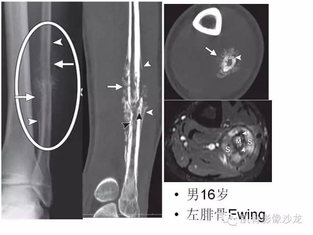 【PPT】重视应力性骨损伤的诊断