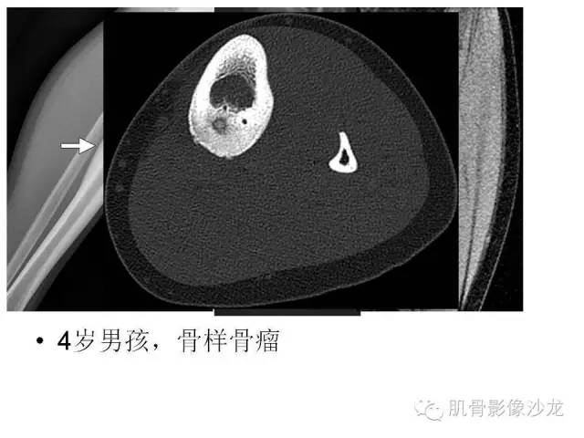 【PPT】重视应力性骨损伤的诊断