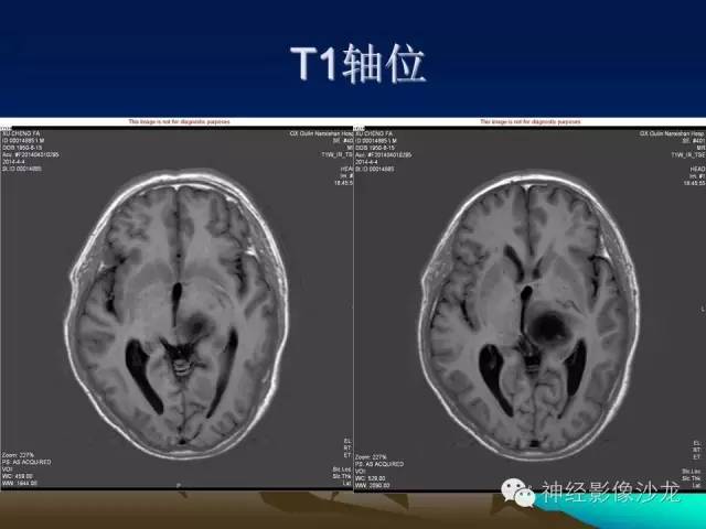 【病例】左侧基底节区血管畸形合并出血一例