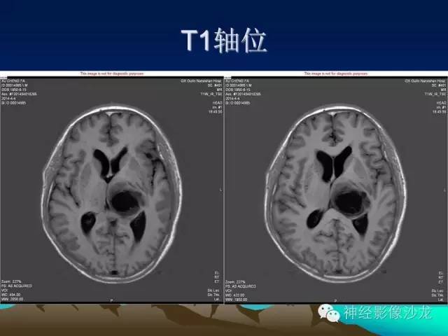【病例】左侧基底节区血管畸形合并出血一例