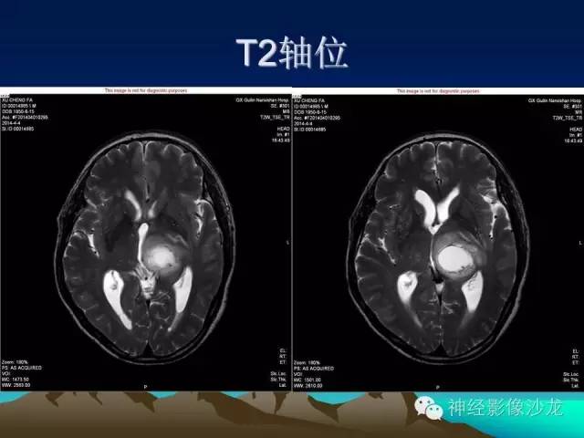 【病例】左侧基底节区血管畸形合并出血一例