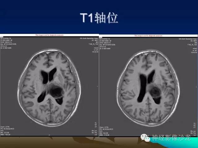 【病例】左侧基底节区血管畸形合并出血一例