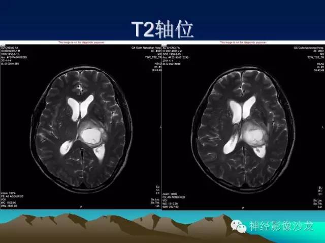 【病例】左侧基底节区血管畸形合并出血一例