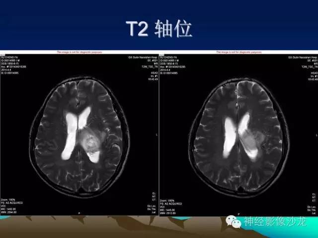 【病例】左侧基底节区血管畸形合并出血一例