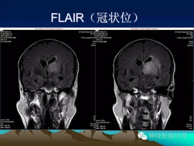 【病例】左侧基底节区血管畸形合并出血一例