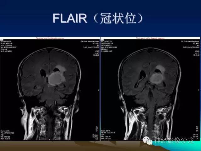 【病例】左侧基底节区血管畸形合并出血一例