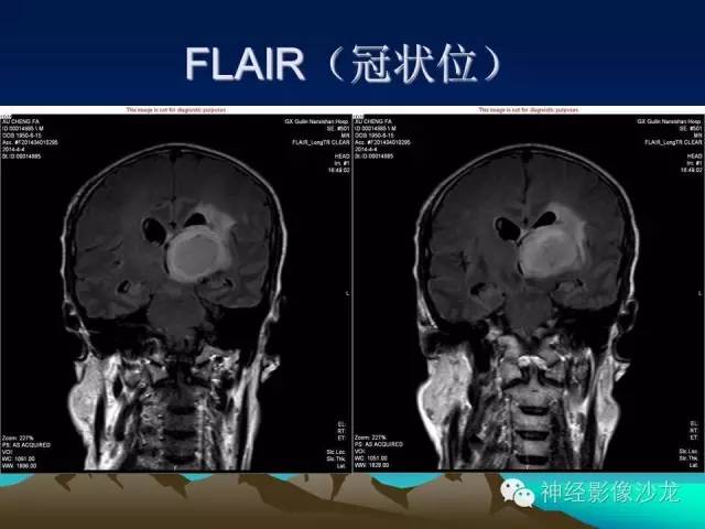 【病例】左侧基底节区血管畸形合并出血一例