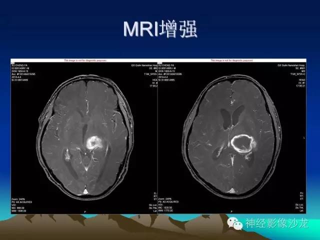 【病例】左侧基底节区血管畸形合并出血一例