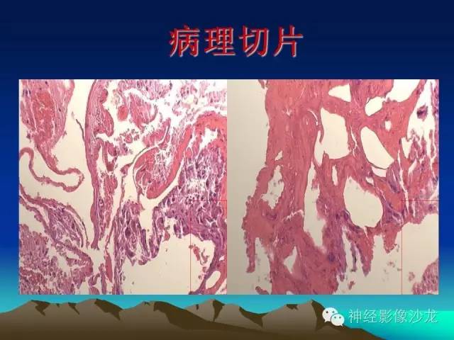 【病例】左侧基底节区血管畸形合并出血一例