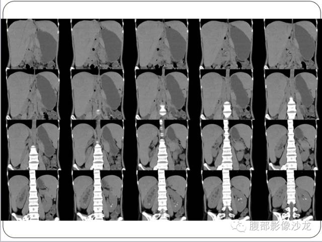 【病例】糖原累积症肝型伴肝腺瘤1例CT 【病例】糖原累积症肝型伴肝腺瘤1例CT