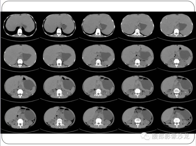 【病例】糖原累积症肝型伴肝腺瘤1例CT 【病例】糖原累积症肝型伴肝腺瘤1例CT