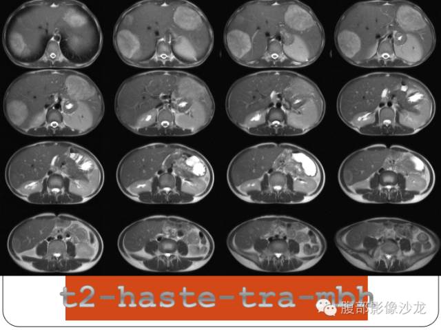 【病例】糖原累积症肝型伴肝腺瘤1例CT 【病例】糖原累积症肝型伴肝腺瘤1例CT