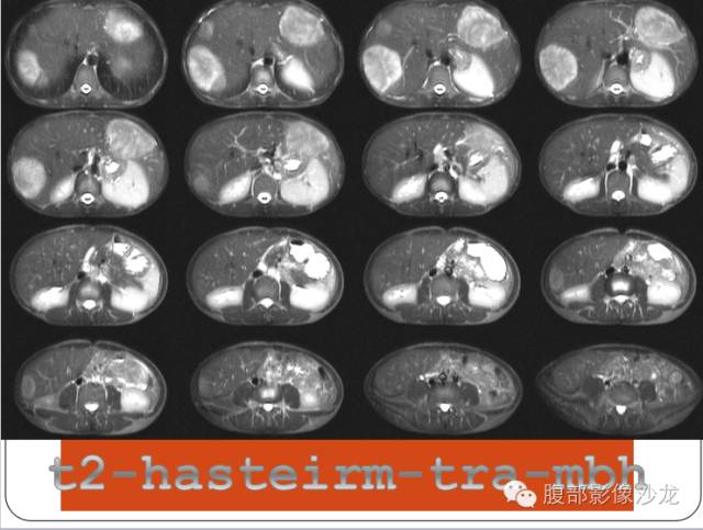 【病例】糖原累积症肝型伴肝腺瘤1例CT 【病例】糖原累积症肝型伴肝腺瘤1例CT