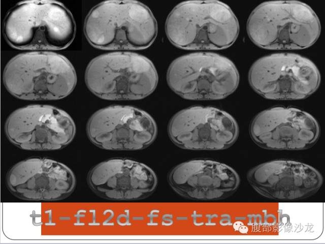 【病例】糖原累积症肝型伴肝腺瘤1例CT 【病例】糖原累积症肝型伴肝腺瘤1例CT