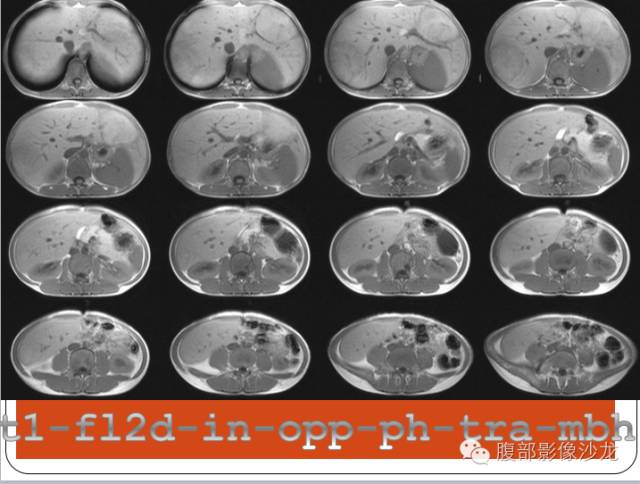 【病例】糖原累积症肝型伴肝腺瘤1例CT 【病例】糖原累积症肝型伴肝腺瘤1例CT