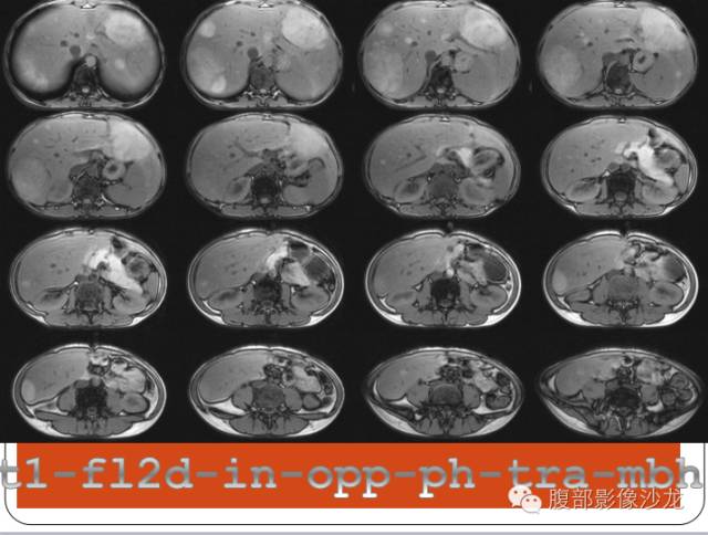 【病例】糖原累积症肝型伴肝腺瘤1例CT 【病例】糖原累积症肝型伴肝腺瘤1例CT