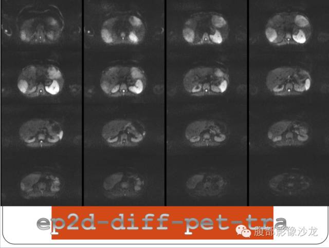 【病例】糖原累积症肝型伴肝腺瘤1例CT 【病例】糖原累积症肝型伴肝腺瘤1例CT
