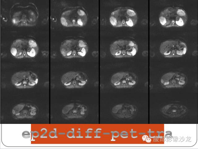 【病例】糖原累积症肝型伴肝腺瘤1例CT 【病例】糖原累积症肝型伴肝腺瘤1例CT